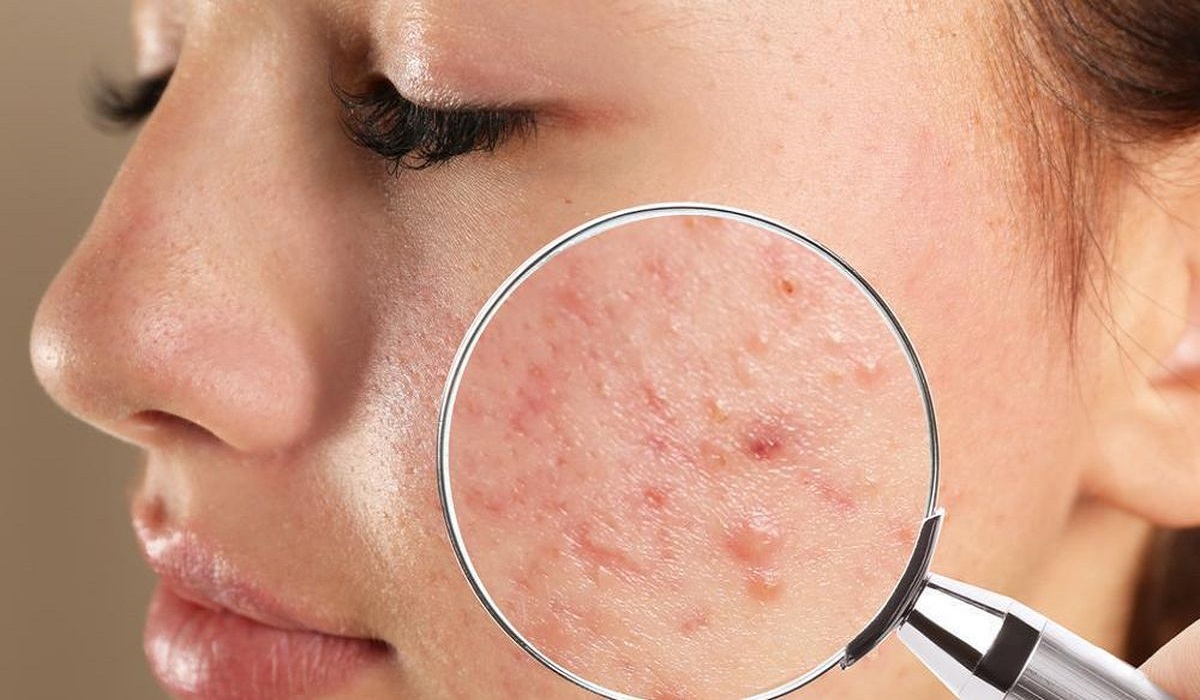 cara mengatasi wajah bruntusan akibat skincare